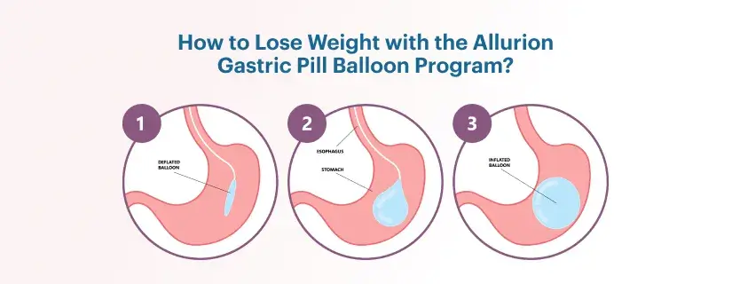 How to Lose Weight with the Allurion Gastric Pill Balloon Program