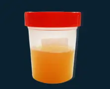 Cloudy Urine