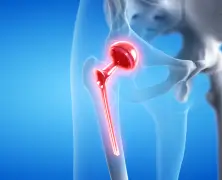 Direct Anterior Approach in Total Hip Replacement