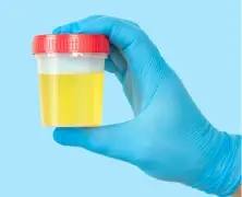 Epithelial Cells in Urine