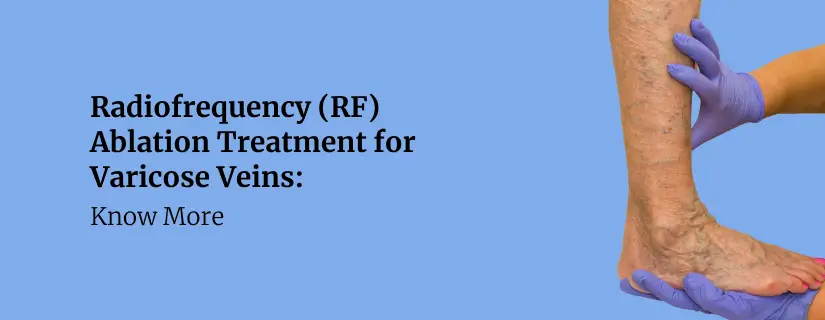 Radiofrequency (RF) Ablation Treatment for Varicose Veins: Know More 