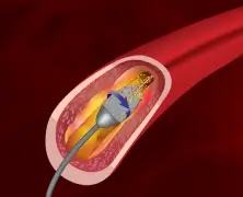 Rotablation Angioplasty