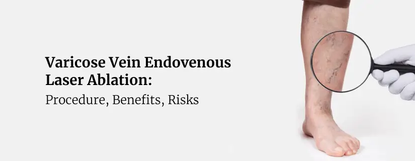 Varicose Vein Endovenous Laser Ablation (EVLA)