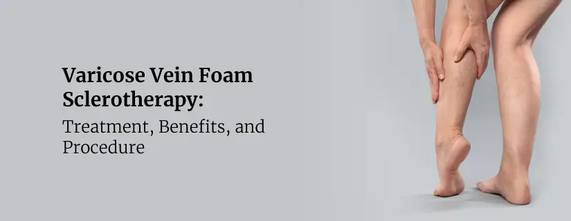 Varicose Vein Foam Sclerotherapy: Treatment, Benefits, and Procedure