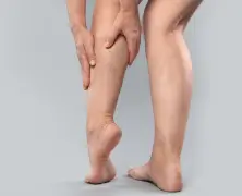 Varicose Vein Foam Sclerotherapy: Treatment, Benefits, and Procedure