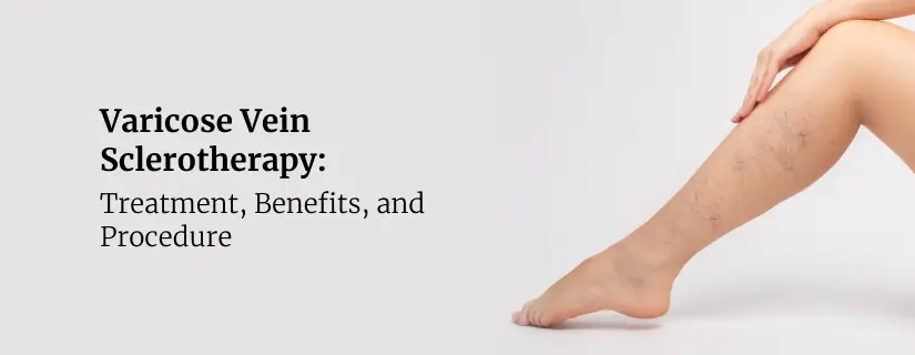 Varicose Vein Sclerotherapy
