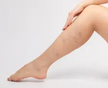 Varicose Vein Sclerotherapy