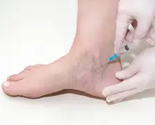 Venous Malformations