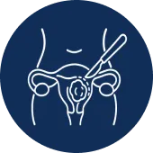 Abdominal Myomectomy