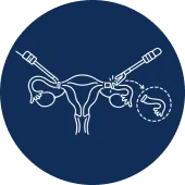 Salpingectomy